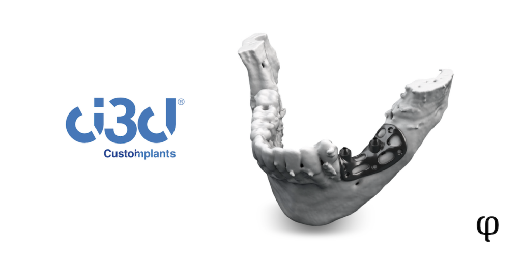 custom-implants