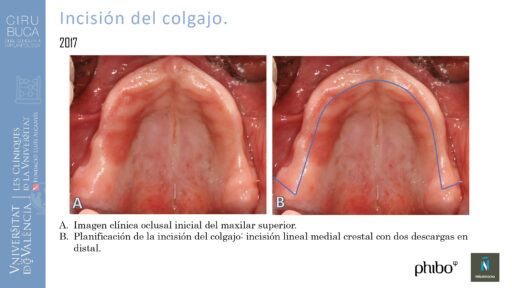 5.Implantes Palatinizados. Implantes Phibo TSA 10_page-0001