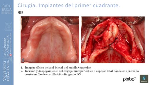 5.Implantes Palatinizados. Implantes Phibo TSA 11_page-0001