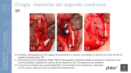 5.Implantes Palatinizados. Implantes Phibo TSA 14_page-0001