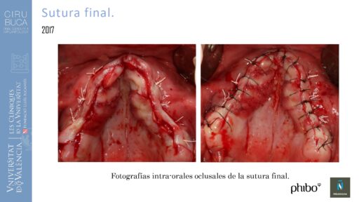 5.Implantes Palatinizados. Implantes Phibo TSA 16_page-0001