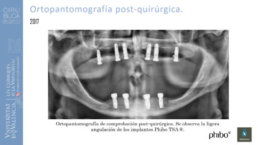 5.Implantes Palatinizados. Implantes Phibo TSA 17_page-0001