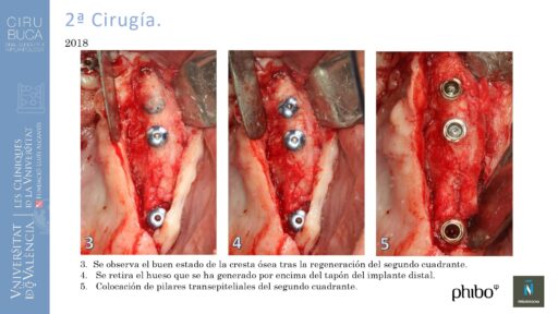 5.Implantes Palatinizados. Implantes Phibo TSA 21_page-0001