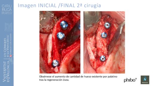 5.Implantes Palatinizados. Implantes Phibo TSA 23_page-0001