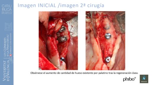 5.Implantes Palatinizados. Implantes Phibo TSA 24_page-0001