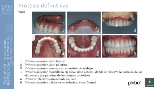 5.Implantes Palatinizados. Implantes Phibo TSA 26_page-0001