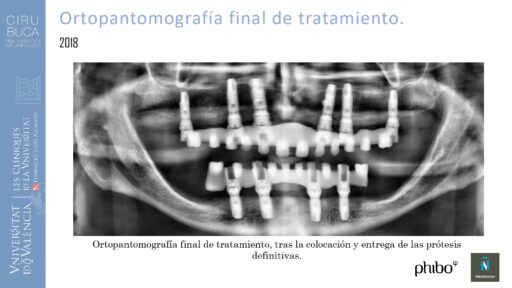 5.Implantes Palatinizados. Implantes Phibo TSA 28_page-0001