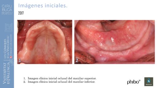 5.Implantes Palatinizados. Implantes Phibo TSA 3_page-0001
