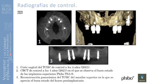 5.Implantes Palatinizados. Implantes Phibo TSA 30_page-0001