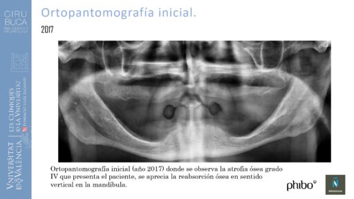 5.Implantes Palatinizados. Implantes Phibo TSA 4_page-0001