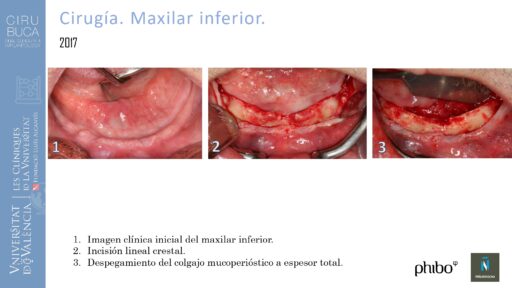 5.Implantes Palatinizados. Implantes Phibo TSA 7_page-0001