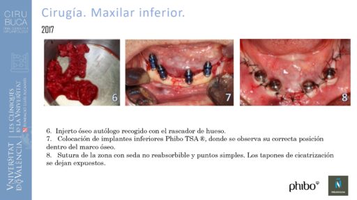 5.Implantes Palatinizados. Implantes Phibo TSA 9_page-0001