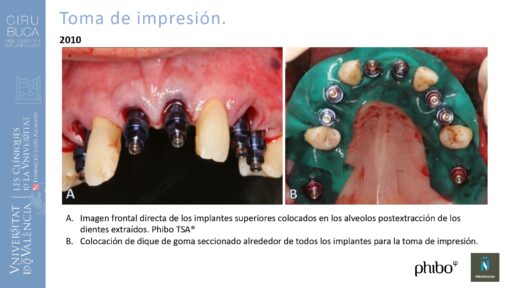 Manuel_Alamar_cirugia_periapical