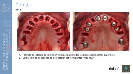 Manuel_Alamar_cirugia_periapical