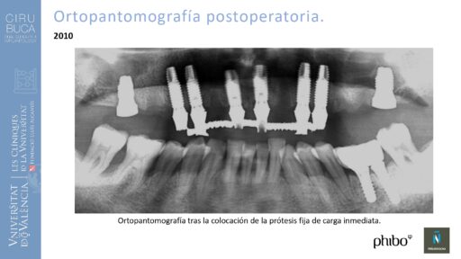 Manuel_Alamar_cirugia_periapical