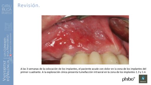 Manuel_Alamar_cirugia_periapical