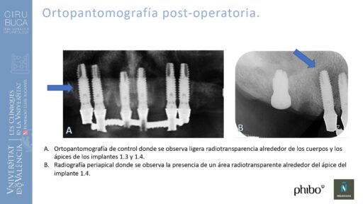 Manuel_Alamar_cirugia_periapical