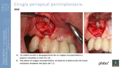 Manuel_Alamar_cirugia_periapical