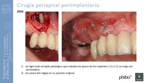 Manuel_Alamar_cirugia_periapical
