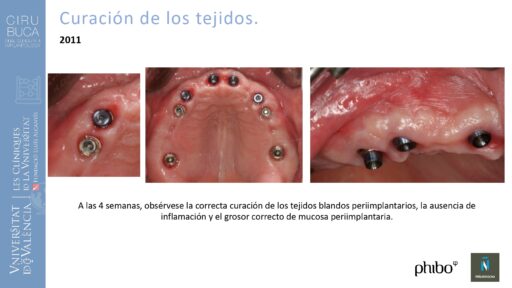 Manuel_Alamar_cirugia_periapical