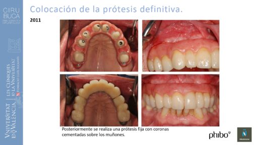 Manuel_Alamar_cirugia_periapical