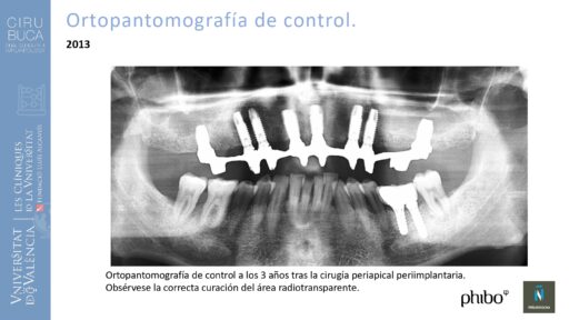 Manuel_Alamar_cirugia_periapical