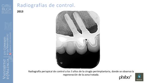Manuel_Alamar_cirugia_periapical
