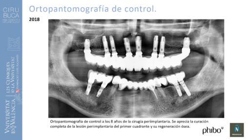Manuel_Alamar_cirugia_periapical