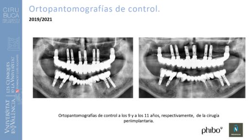 Manuel_Alamar_cirugia_periapical