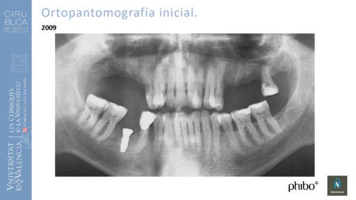 Rodolfo Grau Martinez_cirugia_periimplantaria_periimplantitis_aguda_no_supurada