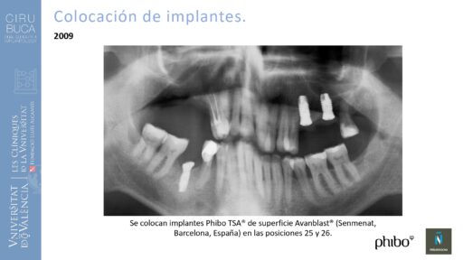 Rodolfo Grau Martinez_cirugia_periimplantaria_periimplantitis_aguda_no_supurada