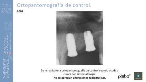 Rodolfo Grau Martinez_cirugia_periimplantaria_periimplantitis_aguda_no_supurada