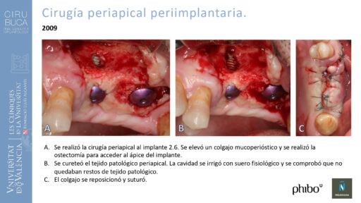 Rodolfo Grau Martinez_cirugia_periimplantaria_periimplantitis_aguda_no_supurada