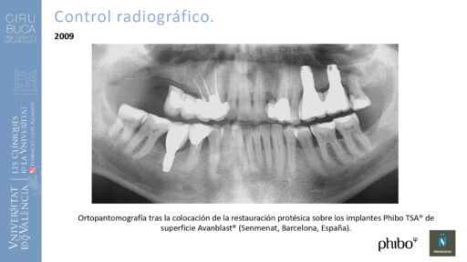 Rodolfo Grau Martinez_cirugia_periimplantaria_periimplantitis_aguda_no_supurada