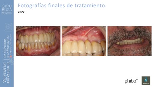 Rodolfo Grau Martinez_cirugia_periimplantaria_periimplantitis_aguda_no_supurada