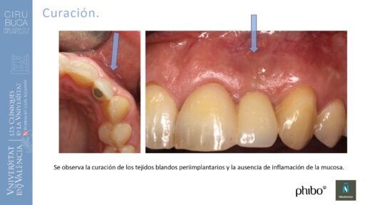 Rosa García Puchades_Cirugia_periapical_periimplantaria