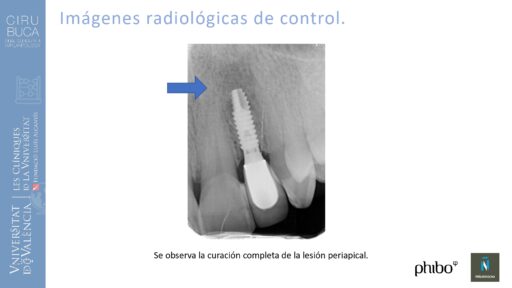 Rosa García Puchades_Cirugia_periapical_periimplantaria