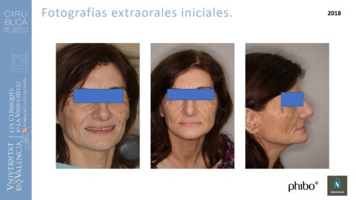 trascigomaticos_e_Implantes_Phibo_TSA