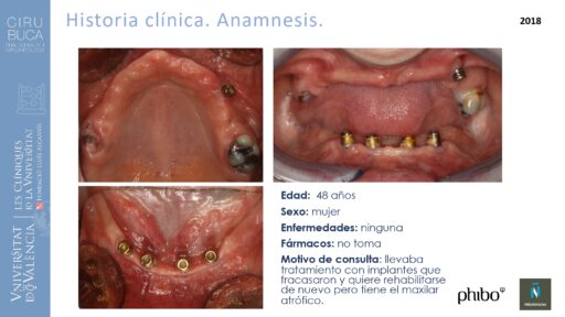 trascigomaticos_e_Implantes_Phibo_TSA
