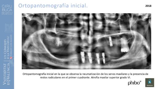 trascigomaticos_e_Implantes_Phibo_TSA