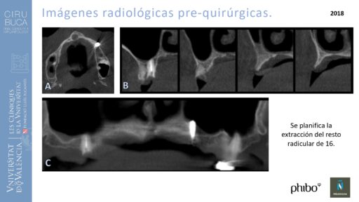 trascigomaticos_e_Implantes_Phibo_TSA