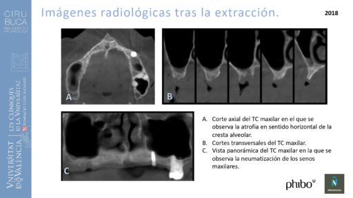 trascigomaticos_e_Implantes_Phibo_TSA