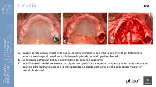 trascigomaticos_e_Implantes_Phibo_TSA