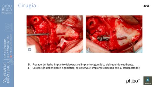 trascigomaticos_e_Implantes_Phibo_TSA