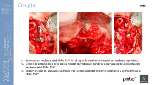 trascigomaticos_e_Implantes_Phibo_TSA