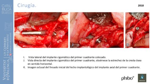 trascigomaticos_e_Implantes_Phibo_TSA