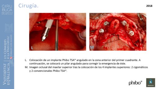trascigomaticos_e_Implantes_Phibo_TSA