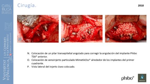 trascigomaticos_e_Implantes_Phibo_TSA