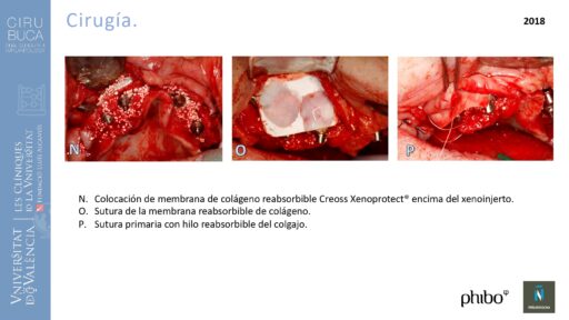 trascigomaticos_e_Implantes_Phibo_TSA