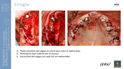 trascigomaticos_e_Implantes_Phibo_TSA